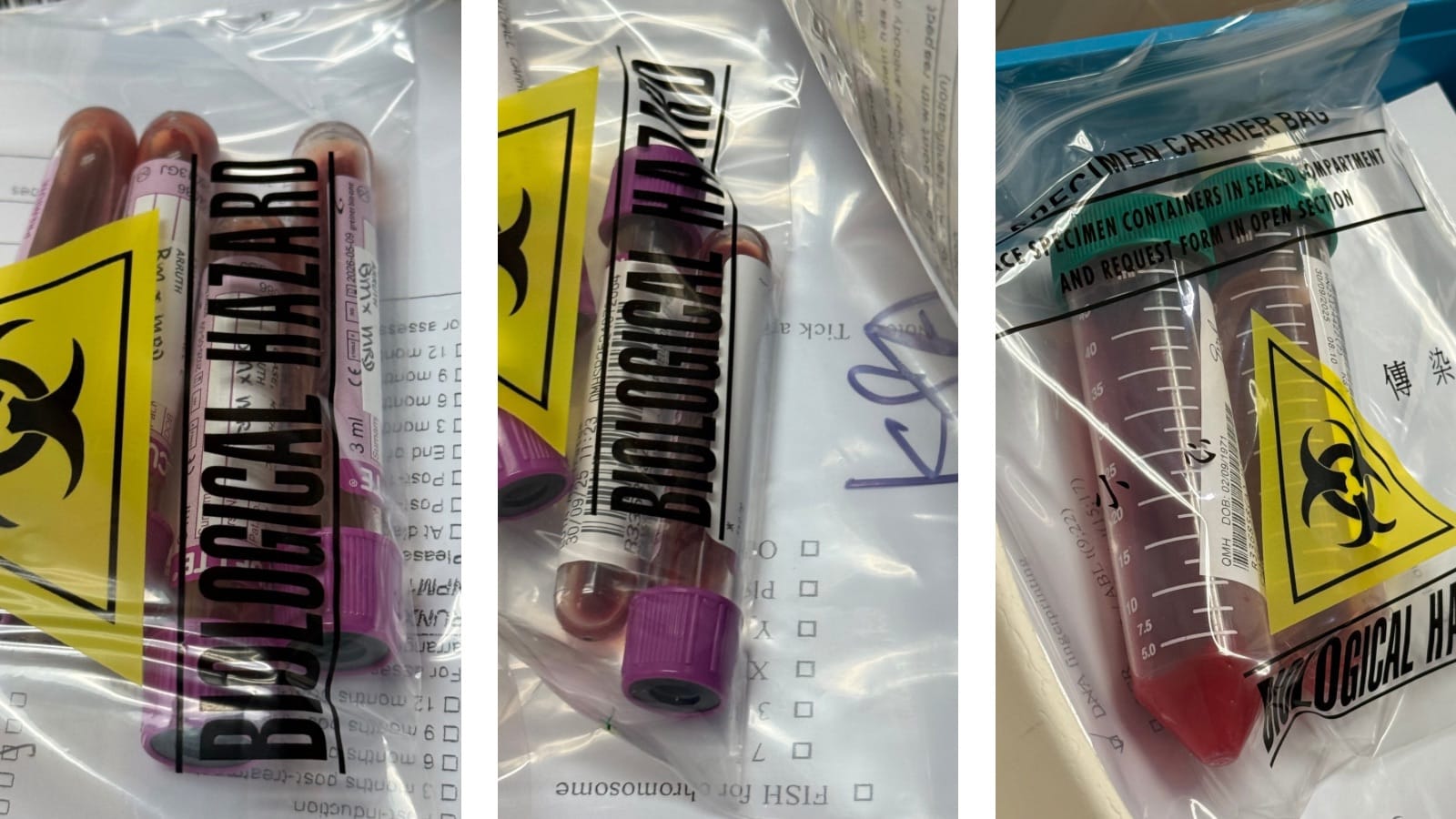 100 Days Post-Transplant